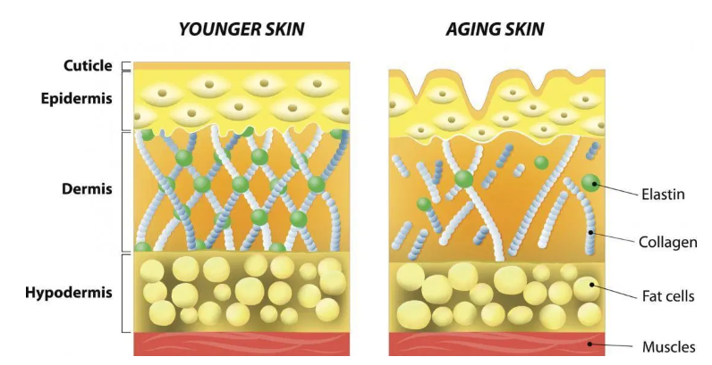 Layers of older skin compared ot younger skin showing the breakdown in collagen 